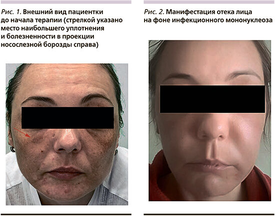 Воспаление филлера из-за инфекционного мононуклеоза