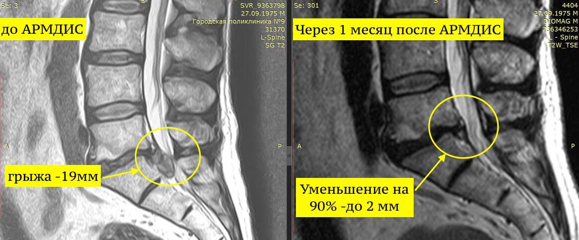  Грыжа межпозвонкового диска — одна из наиболее частых причин болей в спине и конечностях, которая в конечном итоге может потребовать хирургического вмешательства.-4