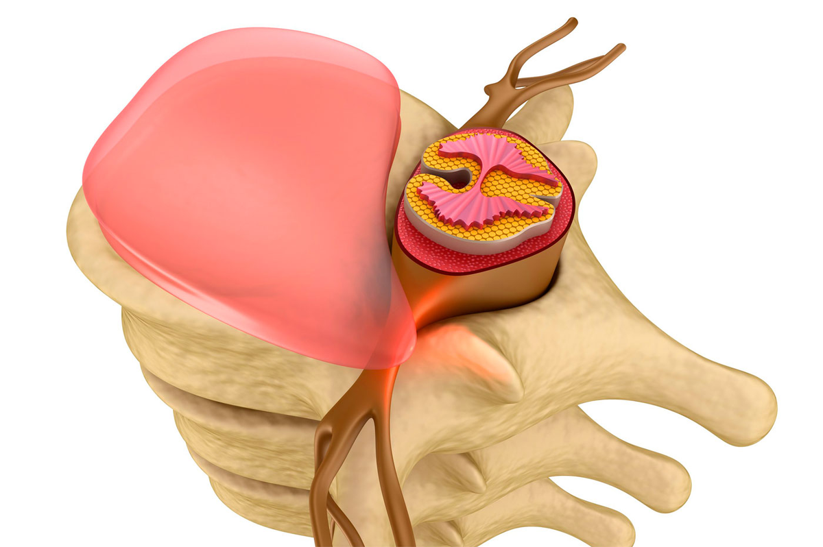  Грыжа межпозвонкового диска — одна из наиболее частых причин болей в спине и конечностях, которая в конечном итоге может потребовать хирургического вмешательства.