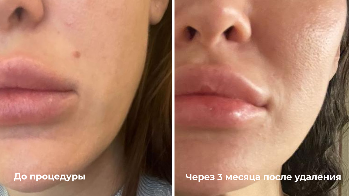 Лазерное удаление меланоцитарного невуса над верхней губой