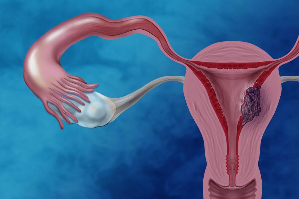 Лечение миомы матки, операция и удаление миомы гистерорезектоскопия