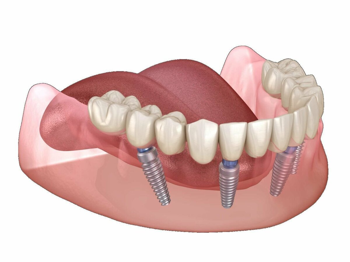 Протез на челюсть без зубов. Имплантация зубов по технологии «all on 4» верхней. Ab Dental имплантаты. Имплантация Neodent.