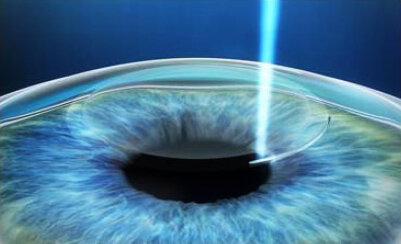 лазерная коррекция зрения (ФемтоЛАЗИК)