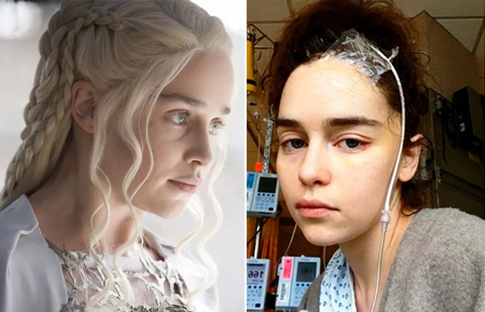 Как живет после трепанации черепа звезда «Игр престолов» Эмилия Кларк ...