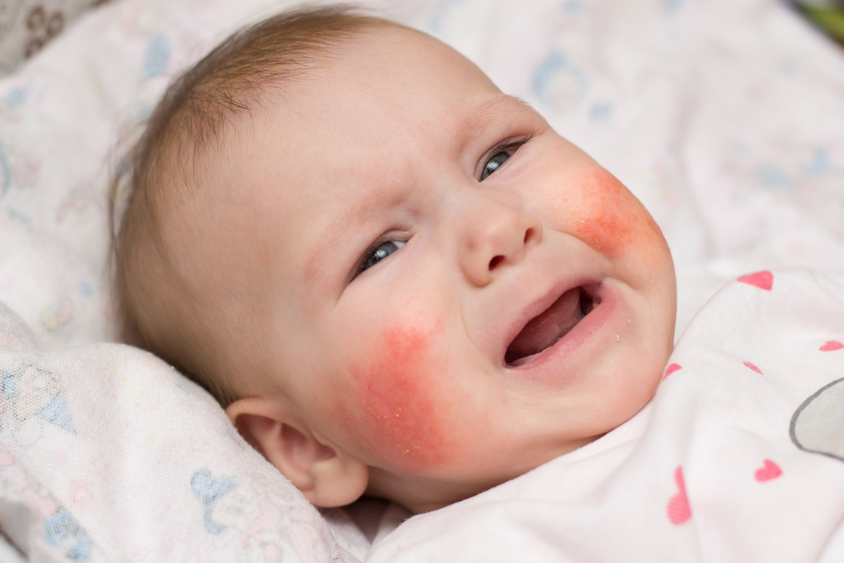Ребенку год красные щеки. Гнейс атопический дерматит. Экссудативный атопический дерматит.