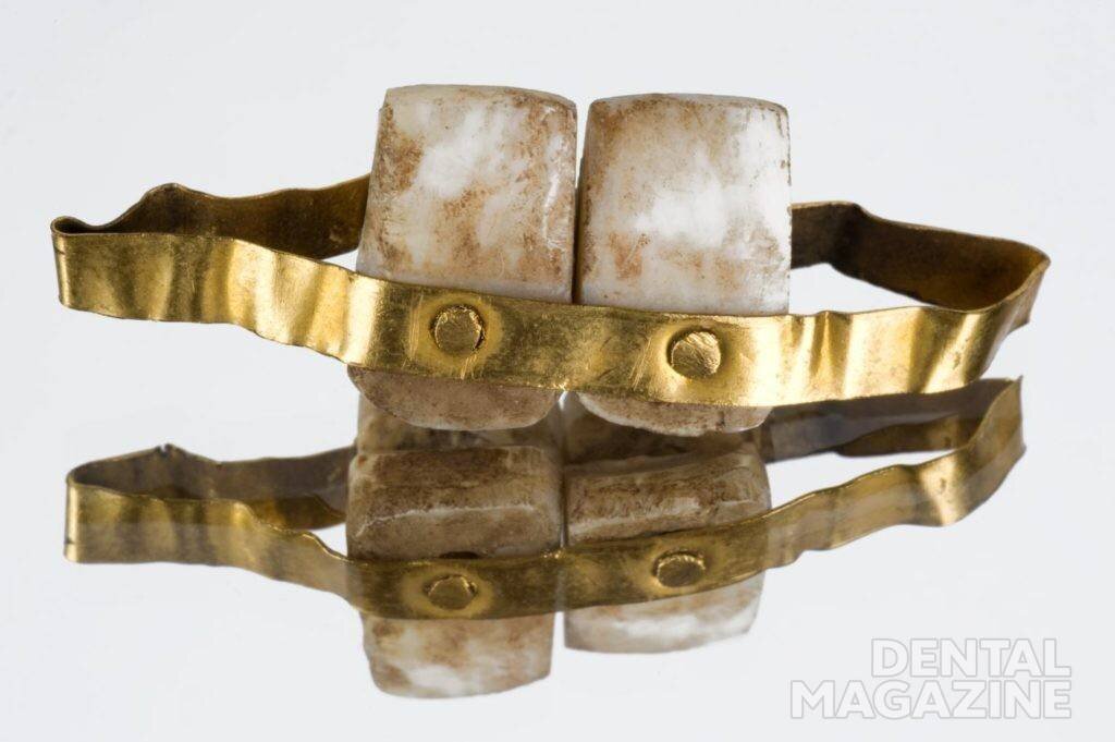 Начало XX века, зубозамещающая конструкция, Источник https://dentalmagazine.ru