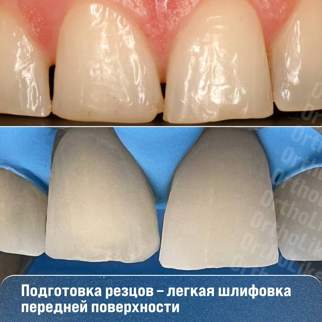 Ортодонтия дети в стоматологии. Прозрачные каппы invisalign. Ортодонтия в стоматологии. Ортодонт после какого класса. Стоматология брекеты.