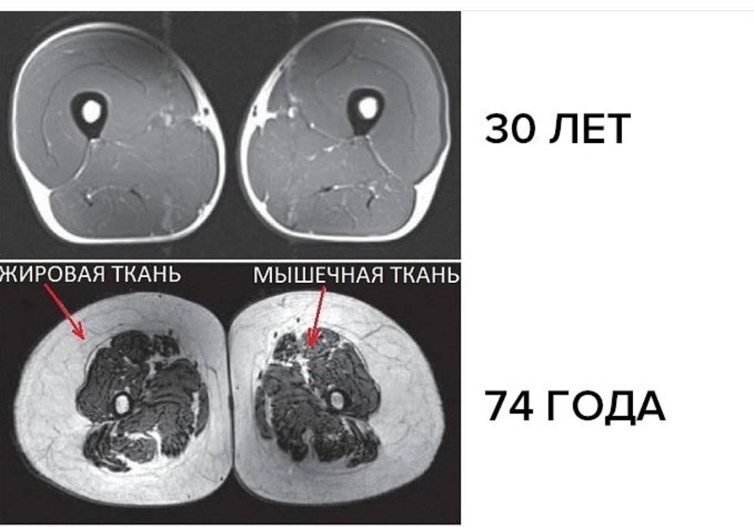 Это знаменитые снимки из интернета, где показан срез бедра человека в возрасте 30 лет и малоподвижного человека в 74 года. Видите тонкий белый ободок у 30 летнего человека — это подкожная жировая прослойка. А у пожилого человека жировая прослойка  уже преобладает над мышечной тканью. Как думаете на сколько легко такому человеку просто пройтись?