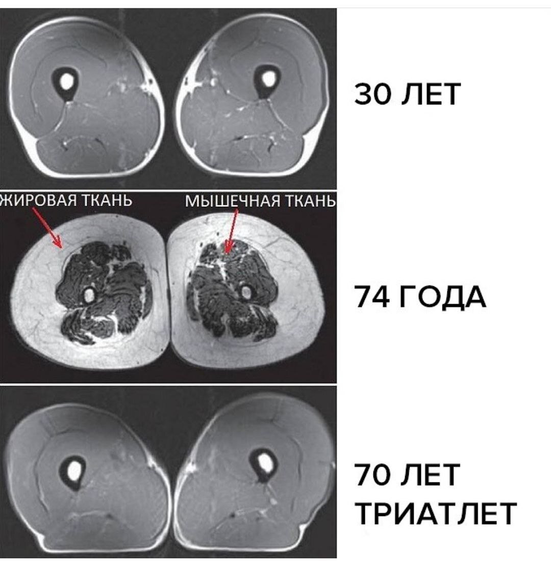 Саркопения. Куда уходят мышцы... Или как сохранить молодость. | Страничка  гастроэнтеролога | Дзен