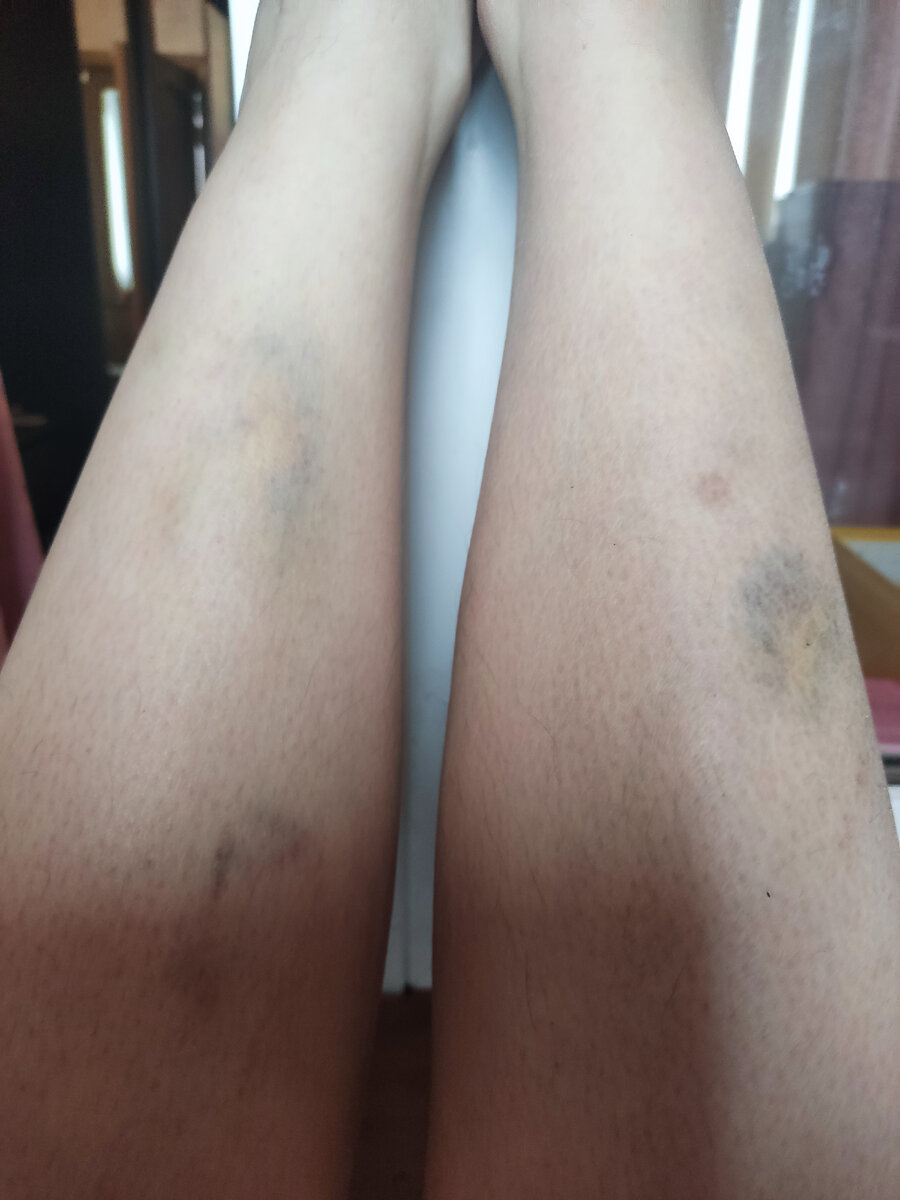 Последствия нарциссического абьюза - фото из архива Кисы. Извините, ноги были не побритые, не до того было.