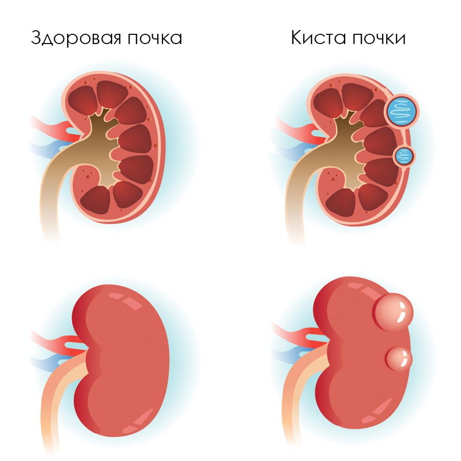 Киста левой почки симптомы