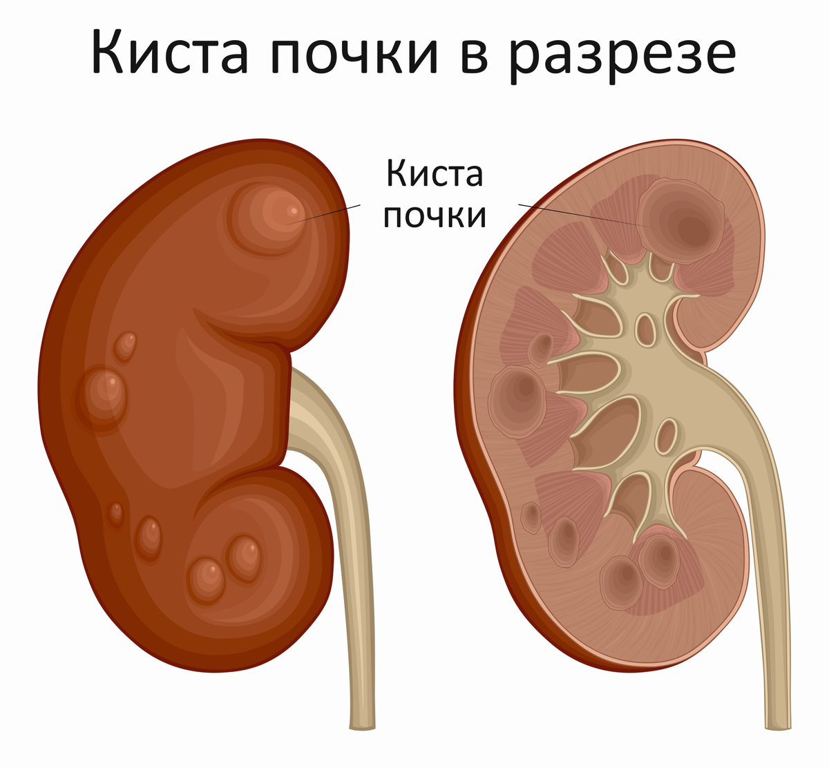 Нашли кисту почки – что это такое, может ли перерасти в рак и нужно ли  немедленно удалять? | О здоровье: с медицинского на русский | Дзен