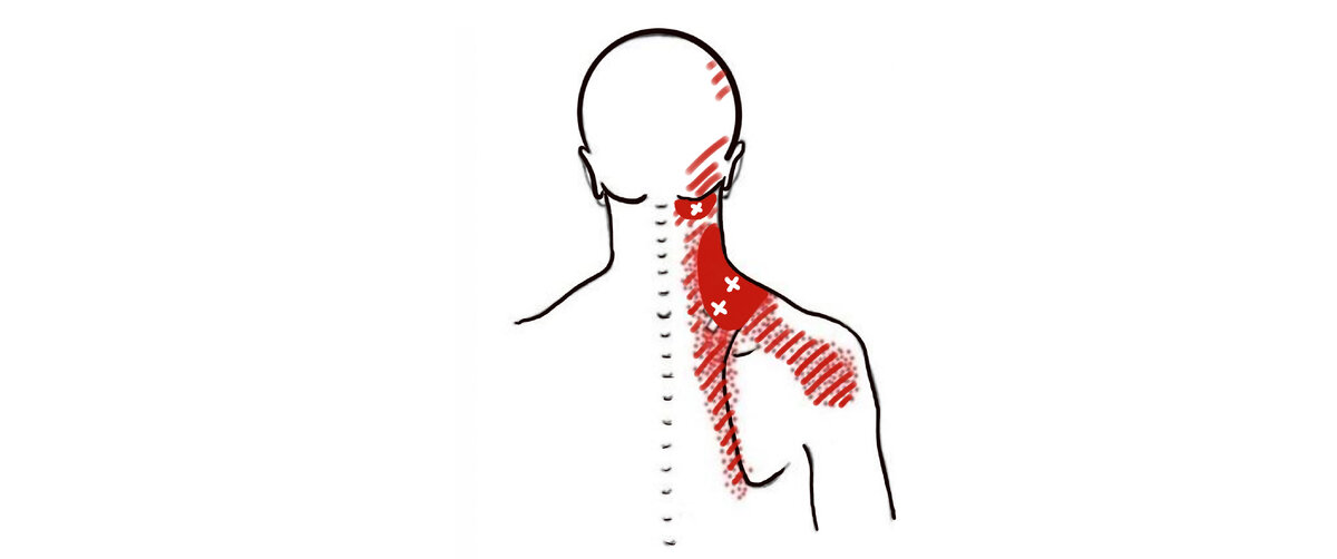 Напряжение и болезненные точки в мышцах плечевого пояса и шеи