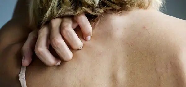 Дискомфорт от укусов и раздражения на коже мешает привычной жизни