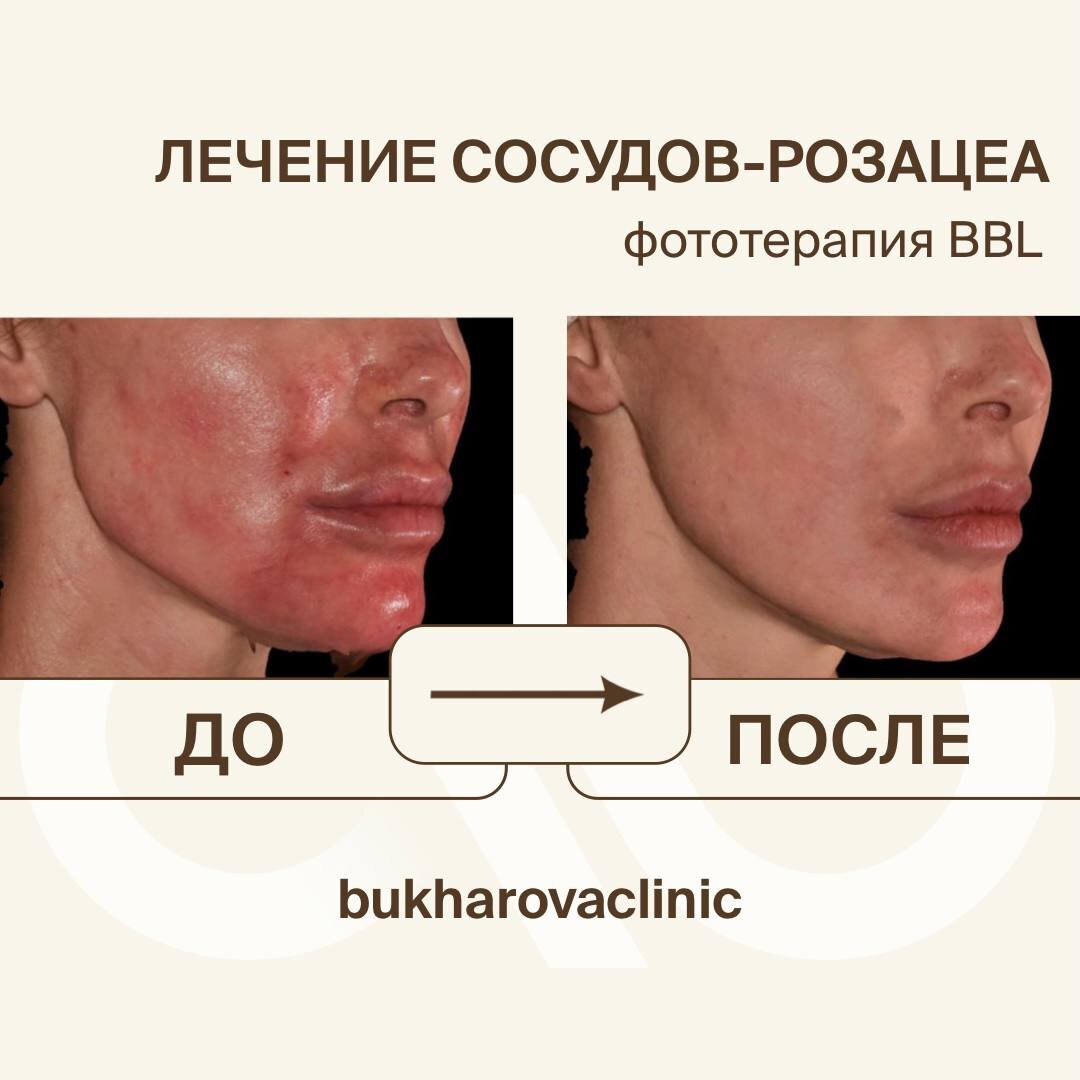 Привет, друзья! Я понимаю, как сосуды на лице могут стать настоящей неудобной темой. Красные пятна, мелкие сеточки – никто не хочет быть художником с собственным лицом, верно?