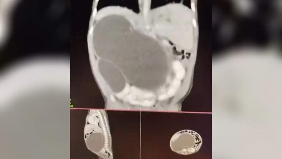 ребенок родился с одной почкой. родился с одной почкой. архангельская детская областная больница хирургия. областная детская клиническая больница архангельск. детки рожденные с одной почкой.
