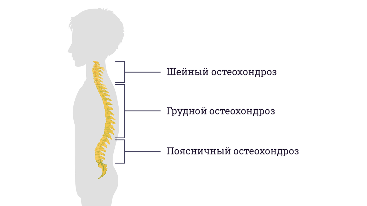 Лечение остеохондроза