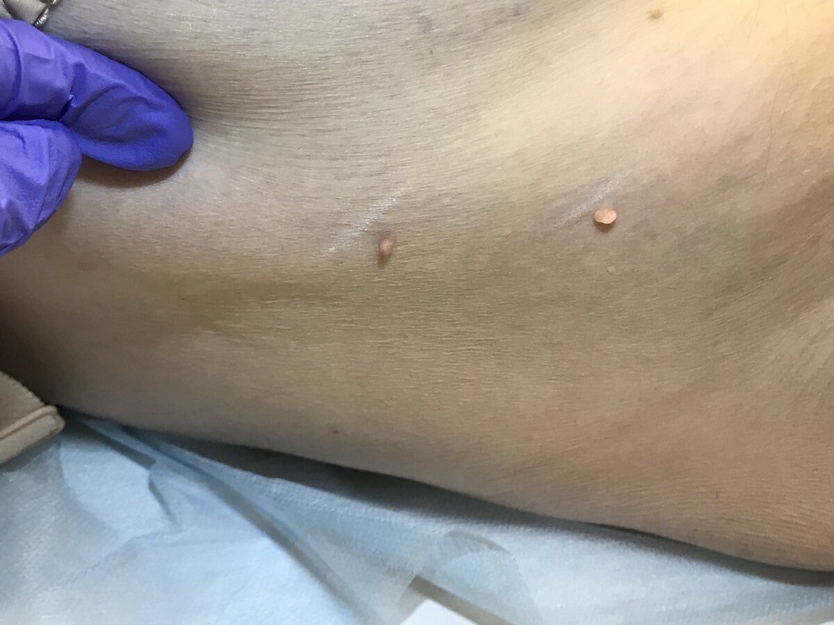 Папилломы до удаления