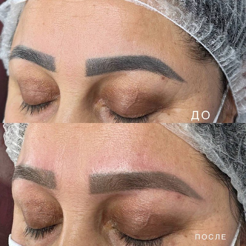 фото До и сразу после первой процедуры удаления 