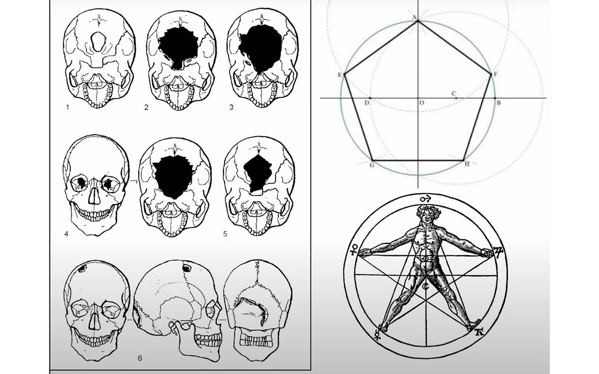 New Archaeology / Youtube📷В третьем ряду показана схема прижизненной трепанации