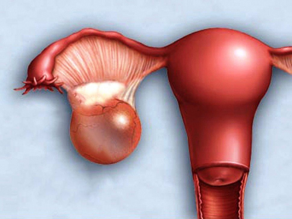 Апоплексия левого яичника. Фолликулярная киста яичника. Лечение яичника у мужчин