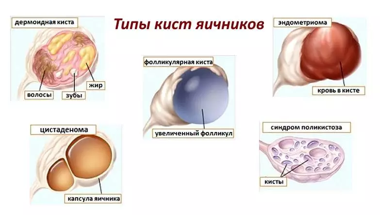 Киста яичника o rads