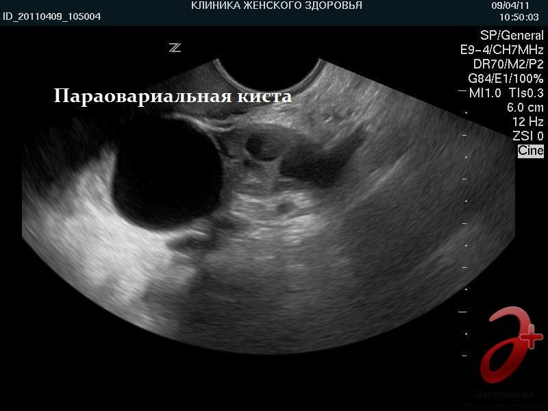 Кисты с двух сторон. Параовариальные кисты яичника. Параовариальная киста на УЗИ яичника. Параовариальная киста справа на УЗИ. Фолликулярная киста яичника на УЗИ.