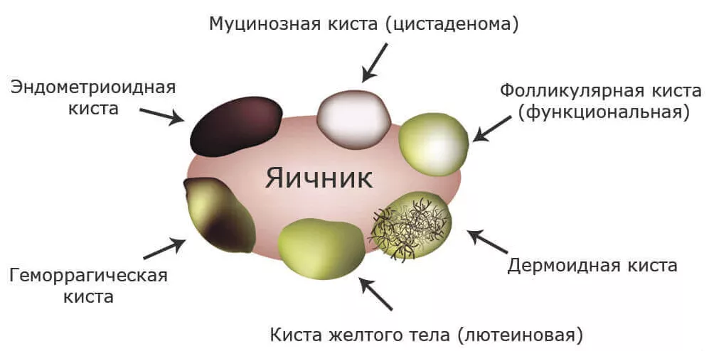 В яичниках образуются ответ. Строение фолликулярной кисты. Функциональные кисты яичников. Фолликулярная (функциональная) киста. Фолликулярные кисты яичников симптомы.