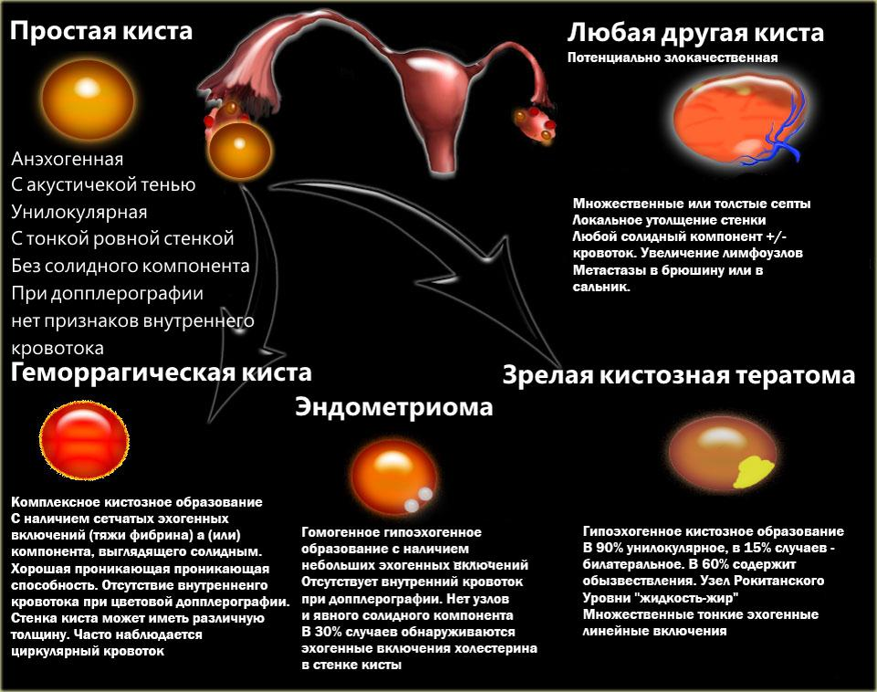 Кистозно солидное образование яичника что это