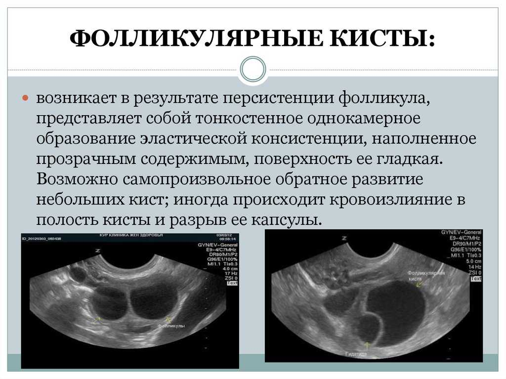 Как выглядит киста яичника фото А она может лопнуть или разорваться? Киста яичника - полный гид по патологии О з