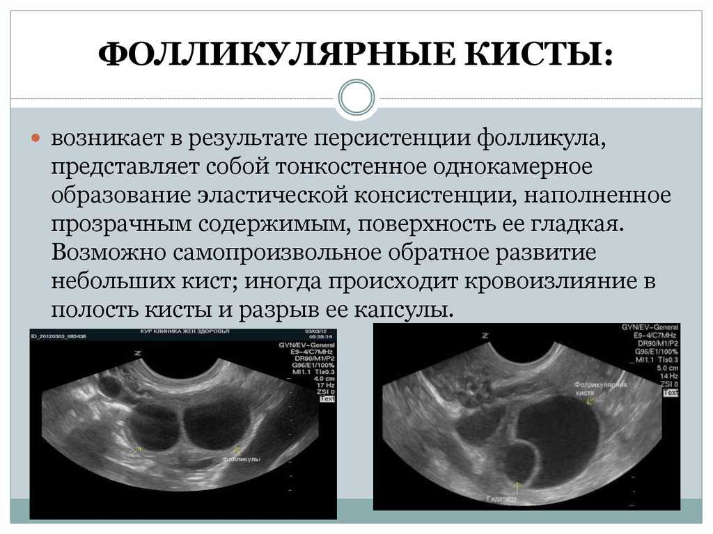 Как отличить кисту. Персистирующий фолликул яичника УЗИ. Фолликулярная киста яичника на УЗИ. Функциональная киста яичника на УЗИ. Фолликулярная киста яичн.