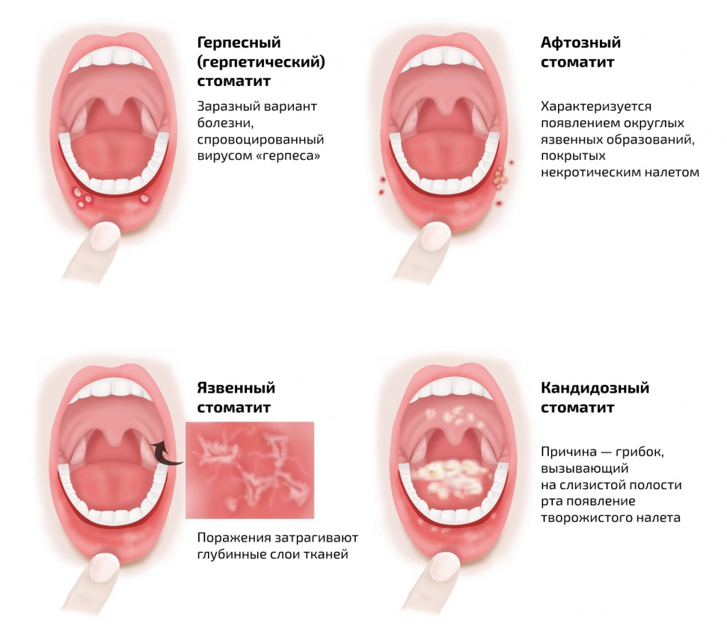 Обработка рта при стоматите. Стомотрт. Стлпатит. Стаомоит.