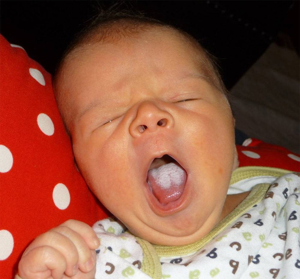 Ребенок с большим ртом. Кандидозный стоматит стоматит. Псевдомембранозный кандидозный стоматит. Грибковый (кандидозный) стоматит.