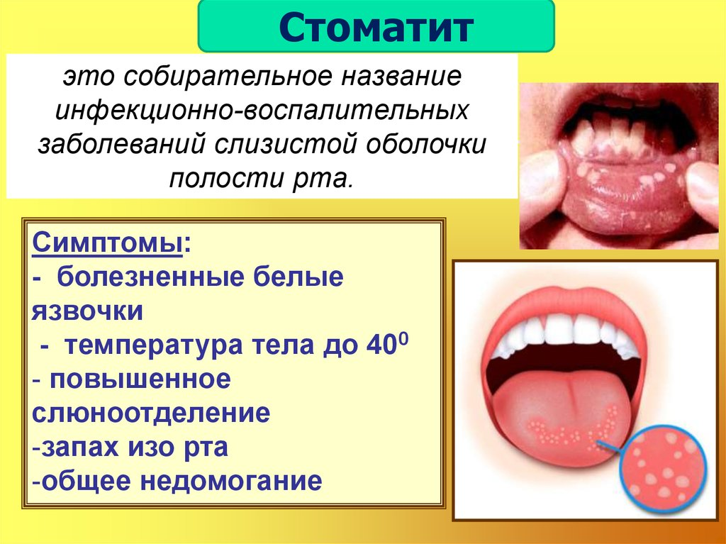 Во рту температура без. Стомотрт. Стлпатит. Стаомоит.