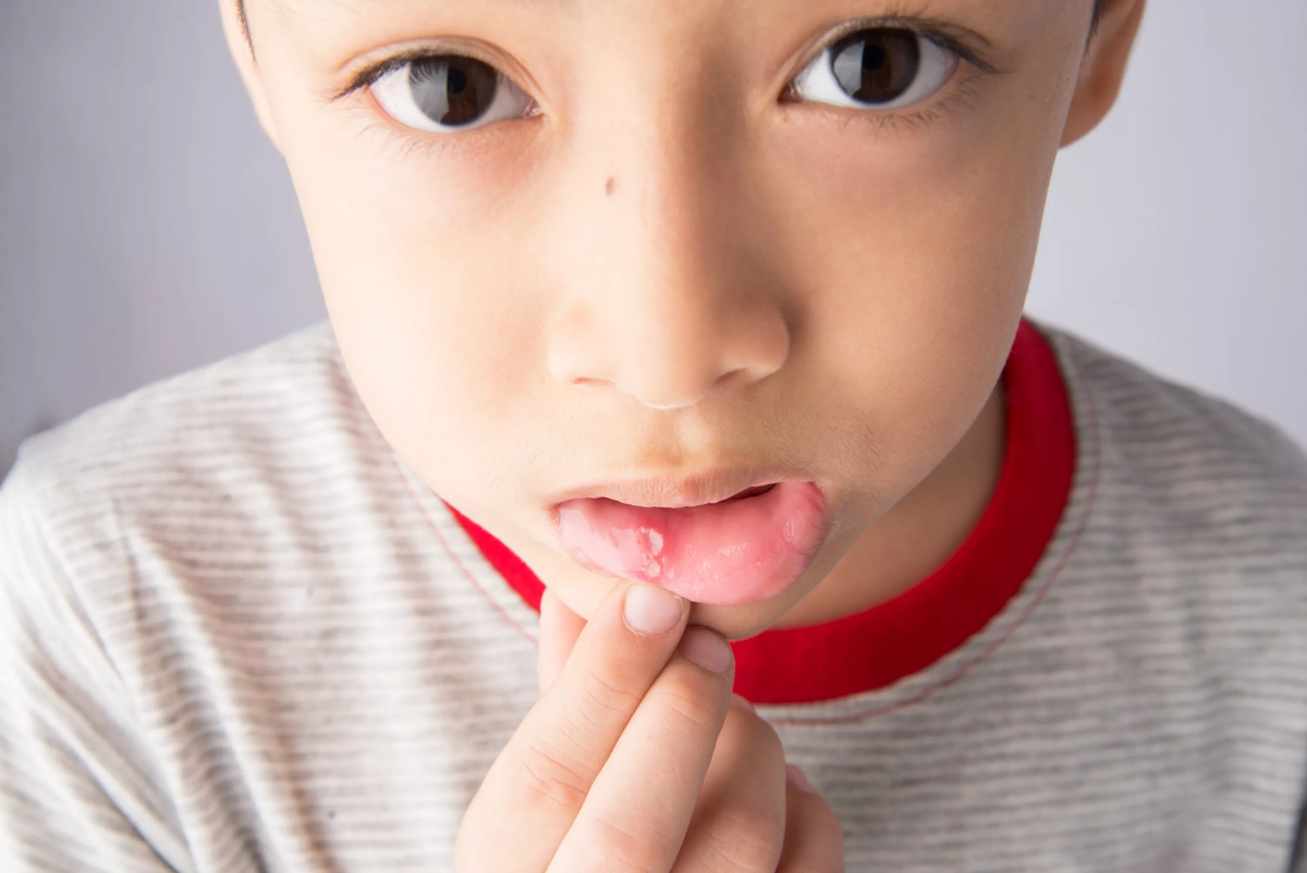 Дети без губ. Афтозный стоматит стоматит. Стоматик.