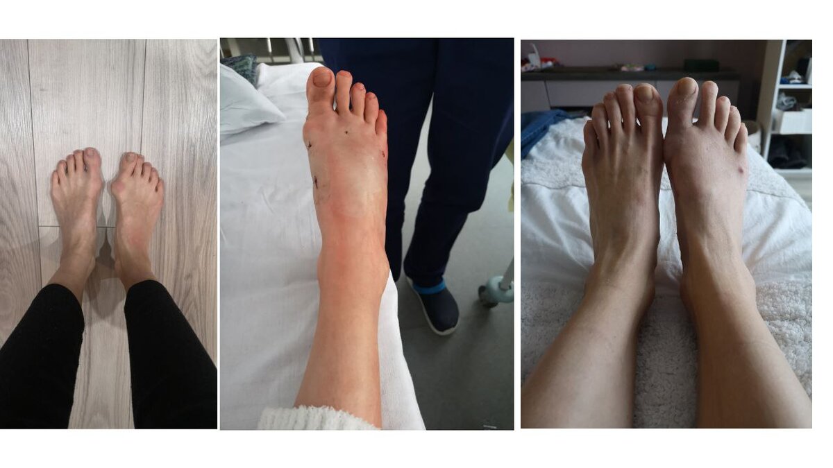 Первое фото - до, второе - на утро после операции, третье - спустя месяц