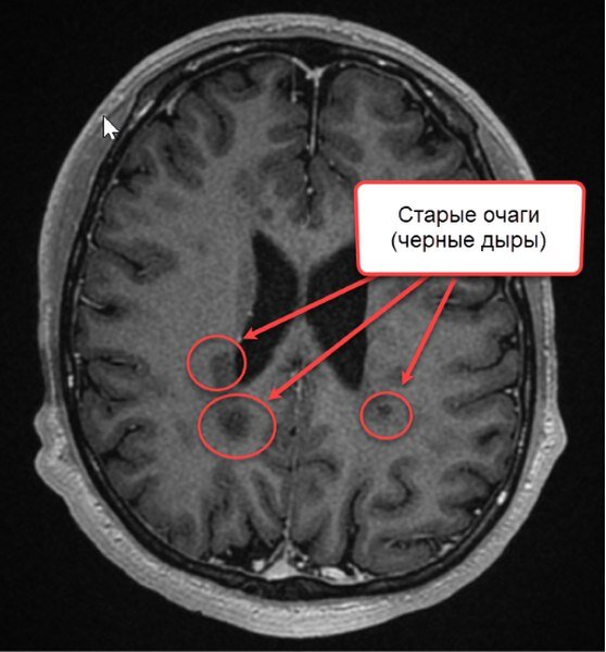 Мр признаки что это означает в мрт