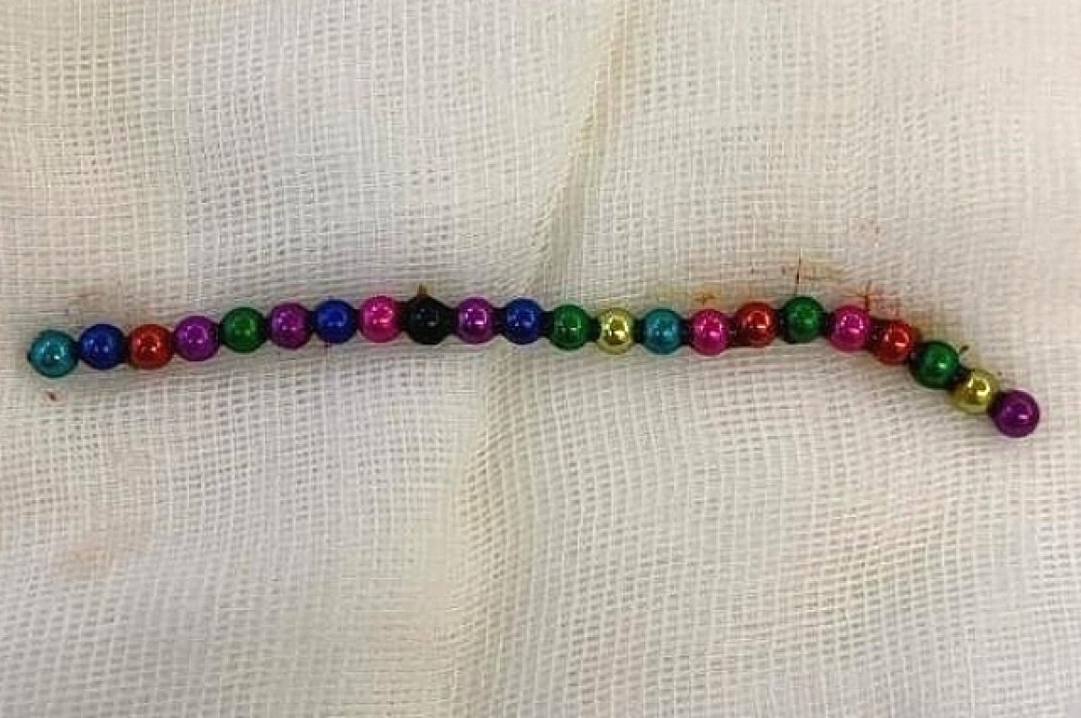    Хирурги Ростова спасли близнецов, проглотивших 67 магнитных шариков