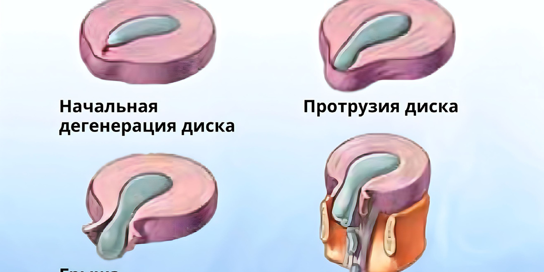 Межпозвоночная грыжа: все, что нужно знать о стадиях и лечении