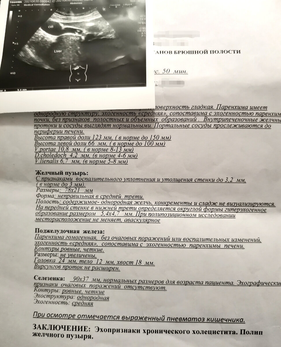 Удаление желчного пузыря: полип, загиб желчного. Холецистэктомия. Жизнь и диета  после удаления желчного. | Повседневное: просто, жизненно и со вкусом | Дзен