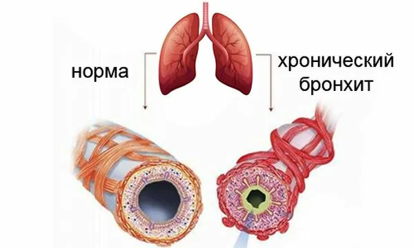 Лечение хронического бронхита - статьи от компании Еламед