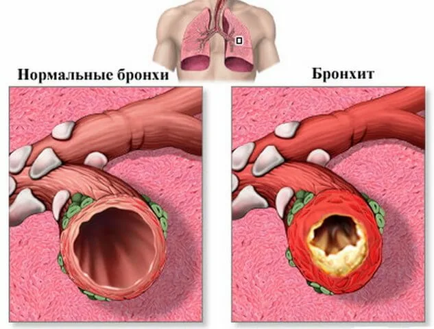 Хронический бронхит у пожилых людей