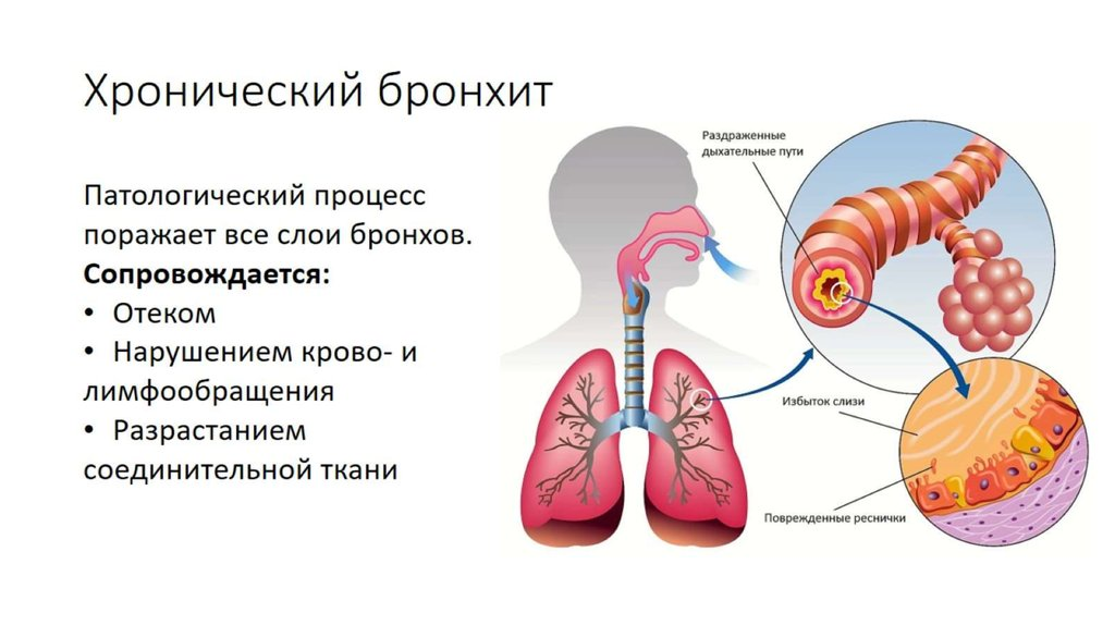 Хронический бронхит у пожилых лечение