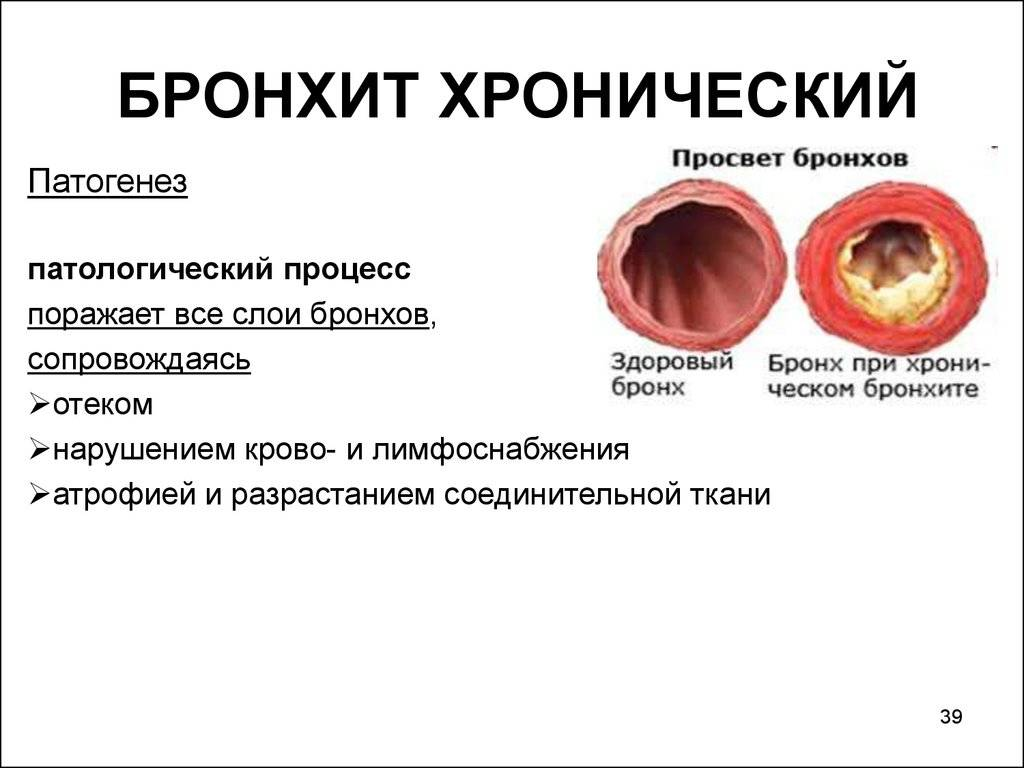 Хронический бронхит анамнез