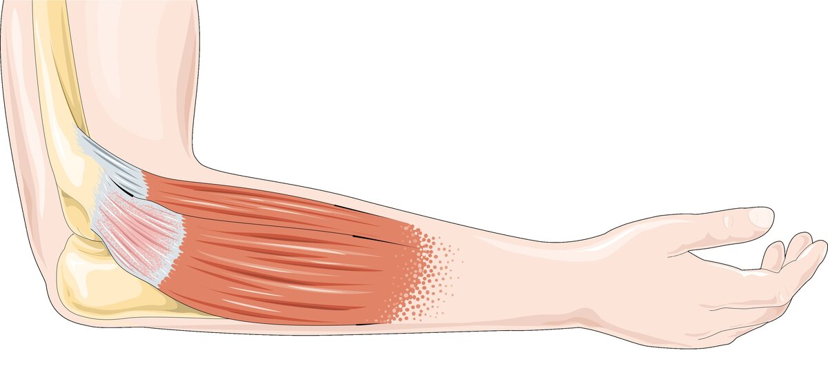 Меры предотвращения повреждений костей мышц. Меры предотвращения повреждений костей мышц. Таблица переломы и первая помощь. Профилактика повреждения мышц и соединительных тканей. Травматизм на физкультуре.