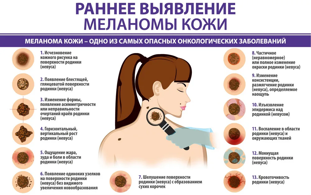 Можно ли находиться на солнце при онкологии. Раковые заболевания кожи. Заболевание кожи меланома.