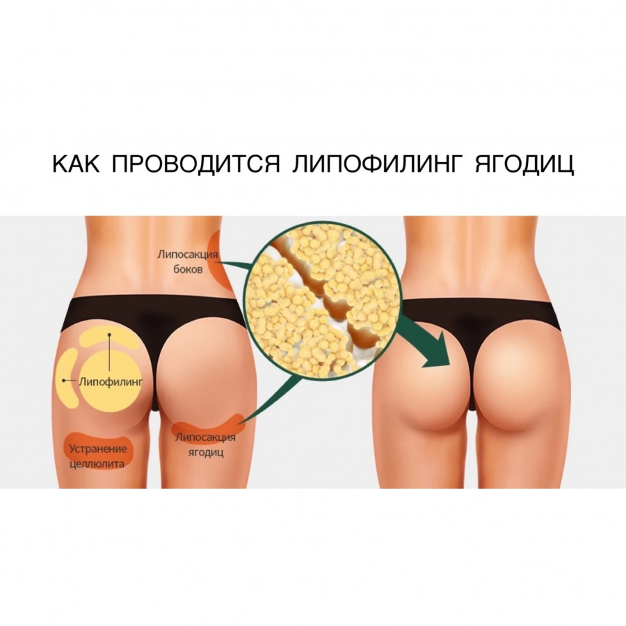 Липофилинг лица реабилитация реабилитация. После липофилинга нельзя. Височный липофилинг. Липофилинг лица реабилитация. Липофилинг лица реабилитация реабилитация.