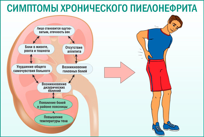 Пиелонефрит (острый и хронический)