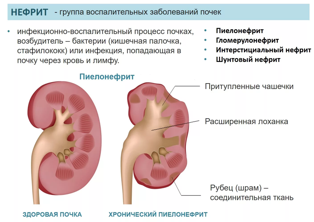 Пиелонефрит человека