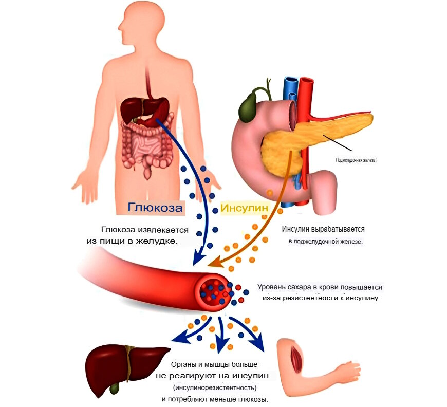 Сестринский процесс при сахарном диабете. Сахарный диабет спроси врача. Сахарный диабет спроси врача. Сахарный диабет спроси врача. Сахарный диабет спроси врача.